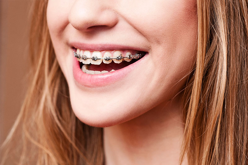 Orthodontics in San Bernardino